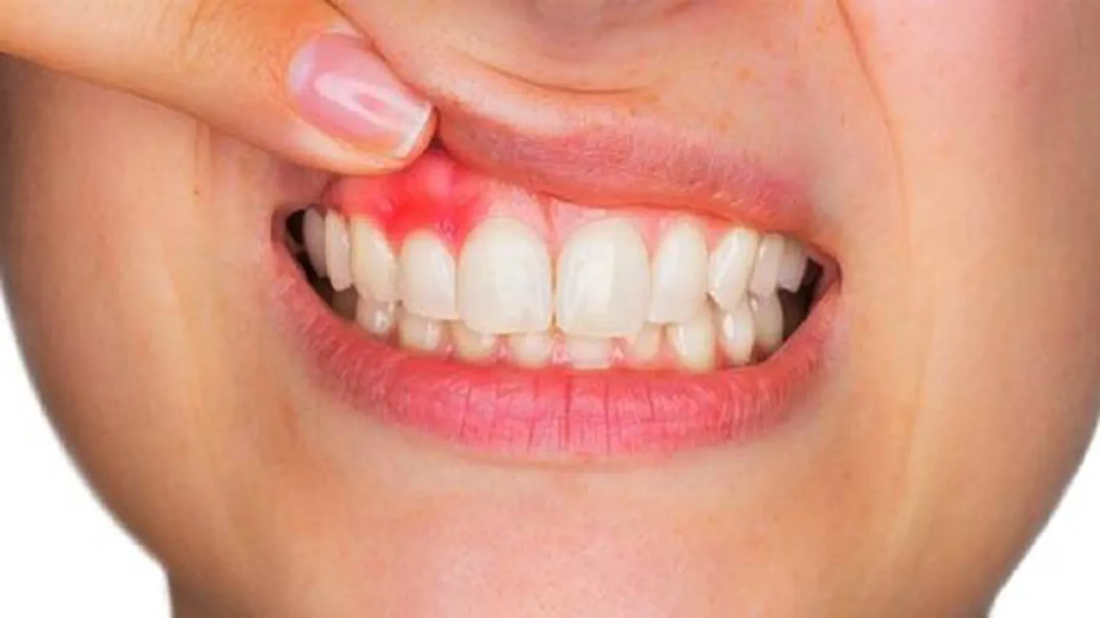 A close-up of a mouth with the upper lip lifted to reveal red, swollen and inflamed gum above a front tooth.