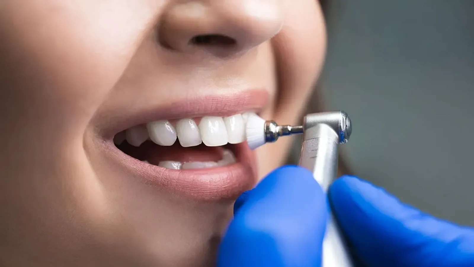 A dentist in blue gloves using a rotating polishing brush to clean a patient's upper front teeth.