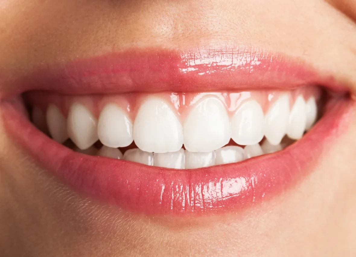 Smile after treatment