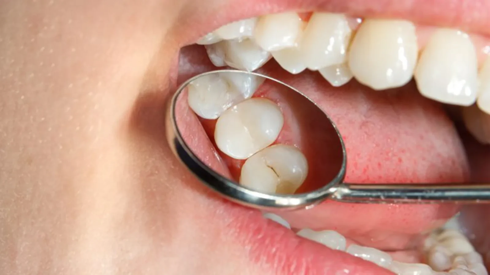 A dental mirror held inside a patient's mouth, reflecting the biting surfaces of the lower back teeth during an examination.