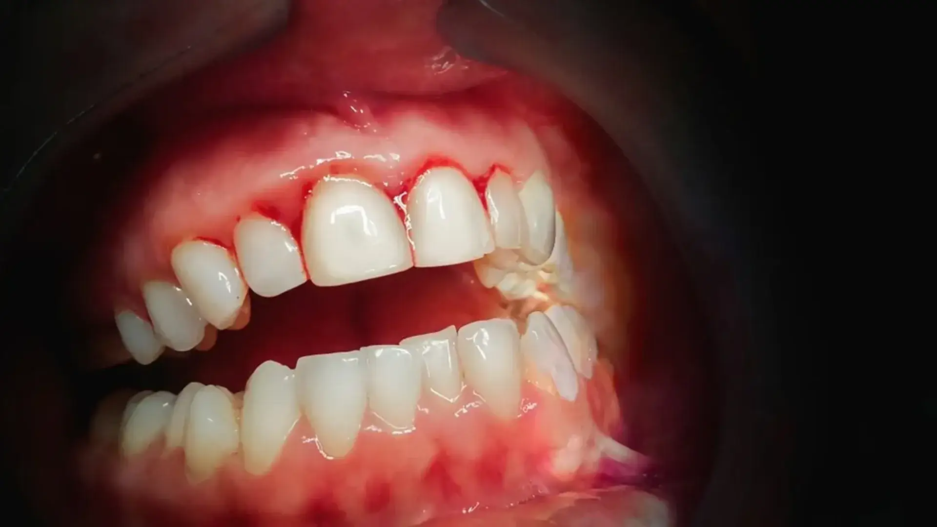 Healthy gums vs inflamed bleeding gums comparison - The Dentart, Sarjapura, Bengaluru