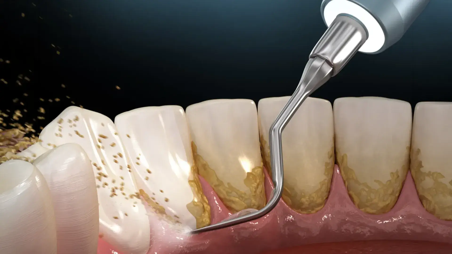 Dentist performing a scale and polish on a patient - The Dentart, Sarjapura, Bengaluru