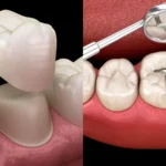 Dental crown and tooth-coloured filling on a tooth model - The Dentart, Sarjapura, Bengaluru