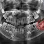 X-ray showing an impacted wisdom tooth - The Dentart, Sarjapura, Bengaluru