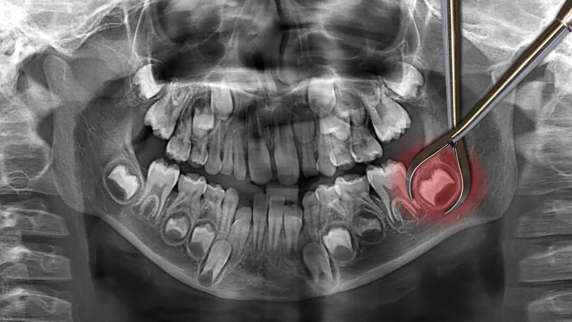 X-ray showing an impacted wisdom tooth - The Dentart, Sarjapura, Bengaluru