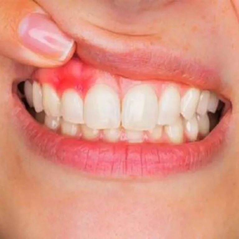 Bleeding Gums & Gum Disease