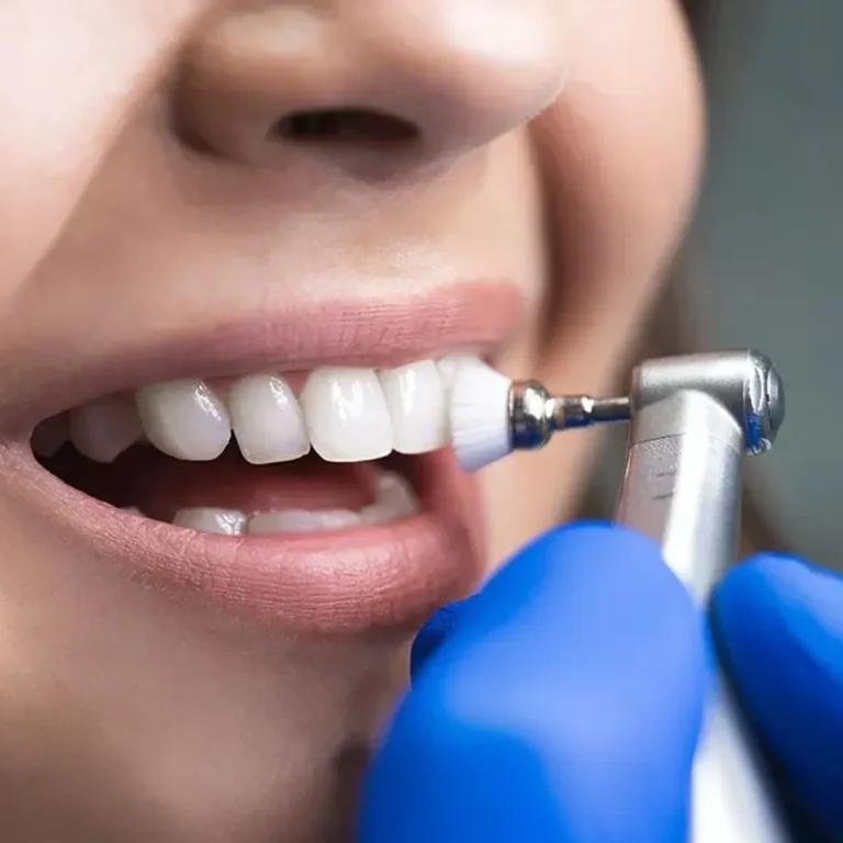 Dental Scaling & Polishing