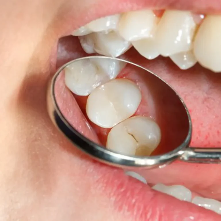 How to Prevent Cavities