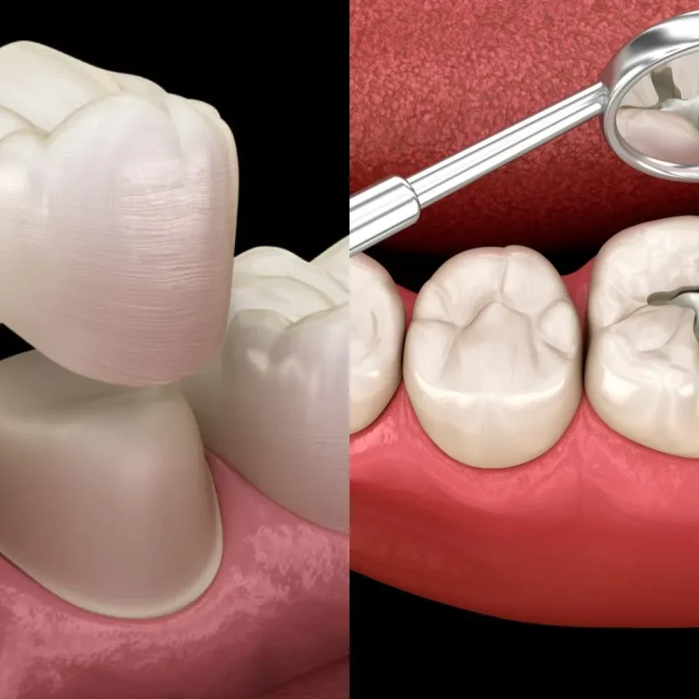Dental crown and tooth-coloured filling on a tooth model - The Dentart, Sarjapura, Bengaluru