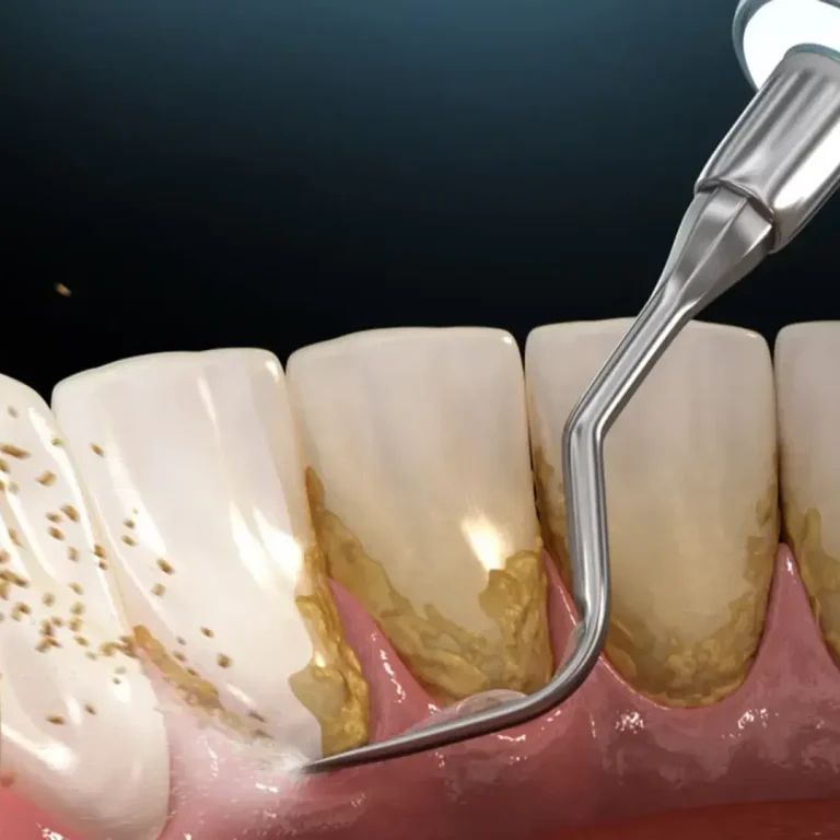 Dentist performing a scale and polish on a patient - The Dentart, Sarjapura, Bengaluru