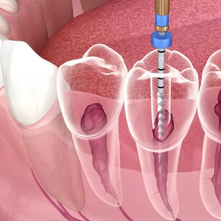 root-canal